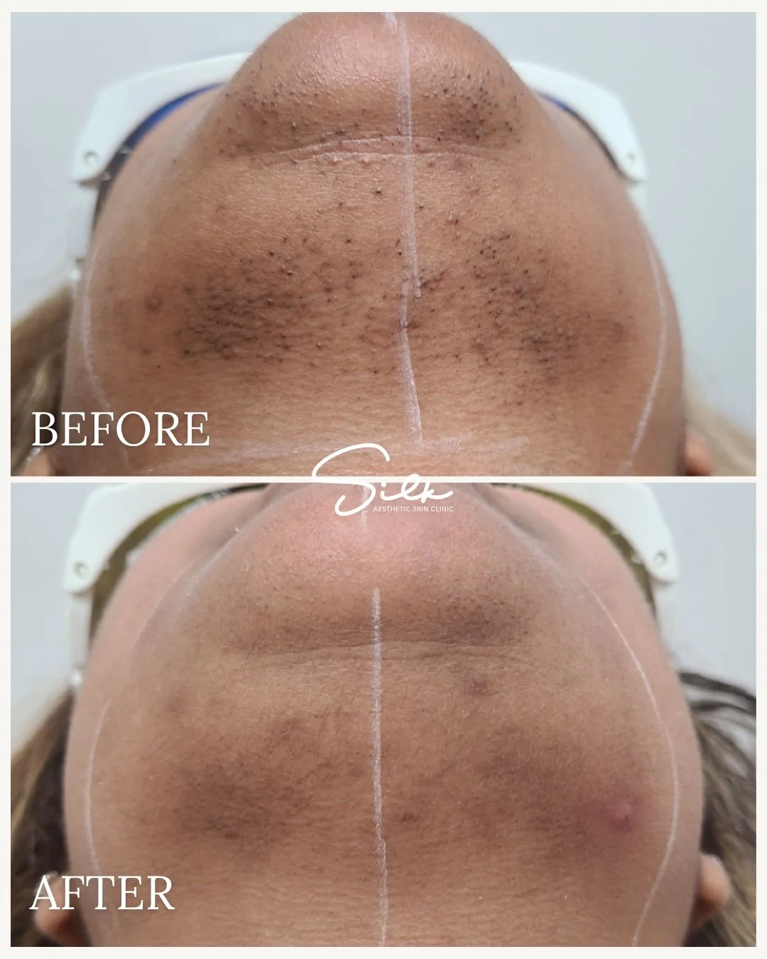 Tired of shaving but still seeing shadows?

This before and after shows how laser hair removal can help reduce the appearance of hair, ingrowns, and dark spots over time.

Smoother-looking skin, less irritation, and long-term results with consistency
