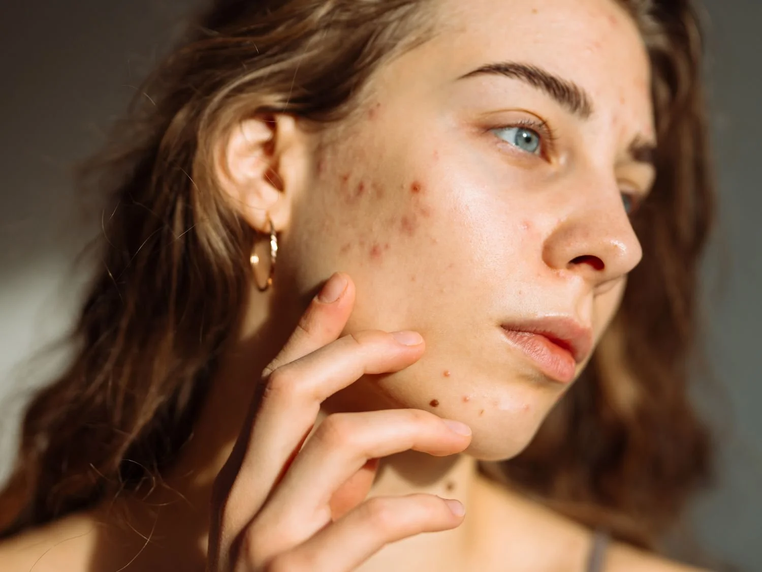 Struggling with Acne Scars? Here Are the Best Treatments That Actually Work