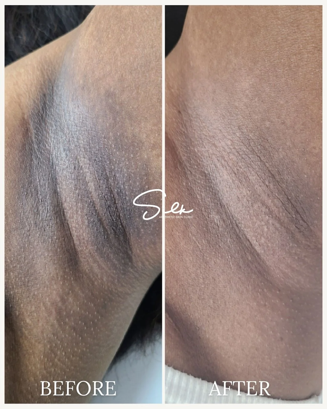 You don&rsquo;t have to hide your underarms anymore.

This before and after shows improvement in the appearance of dark underarms with consistent, targeted treatments designed to smooth texture and even out skin tone.

Brighter, more even-looking ski