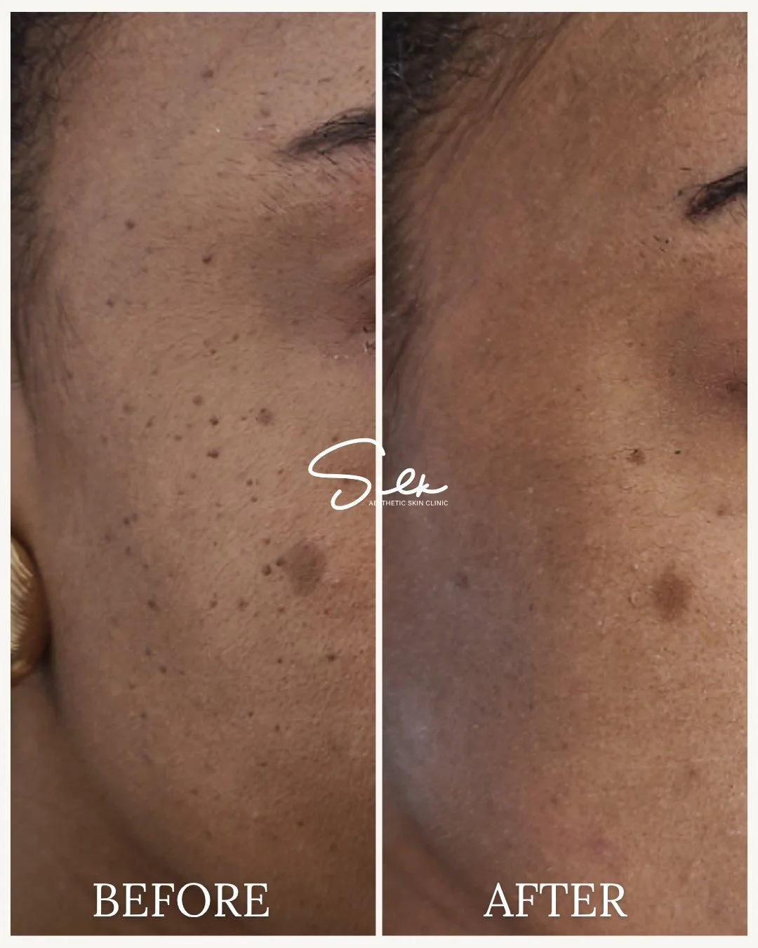 Those tiny bumps? They&rsquo;re not permanent

Skin tags can make the skin look uneven and textured, but with the right treatment, they can be safely and effectively removed for a smoother, clearer appearance.

Notice the difference in skin texture a