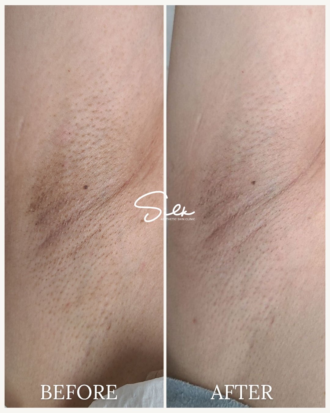 If your underarms are getting darker no matter what you try&hellip; this is why.

It&rsquo;s not just about surface pigmentation.

Years of shaving, friction, and irritation build up deeper in the skin, which is why most products don&rsquo;t give las