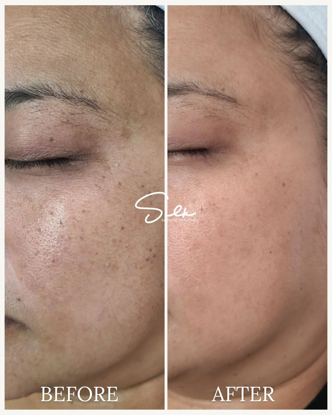 Those dark spots don&rsquo;t have to stay forever

This is what targeted treatment and consistency can do. Notice the improvement in pigmentation, skin tone, and overall brightness. It&rsquo;s not about covering it up, it&rsquo;s about correcting it.