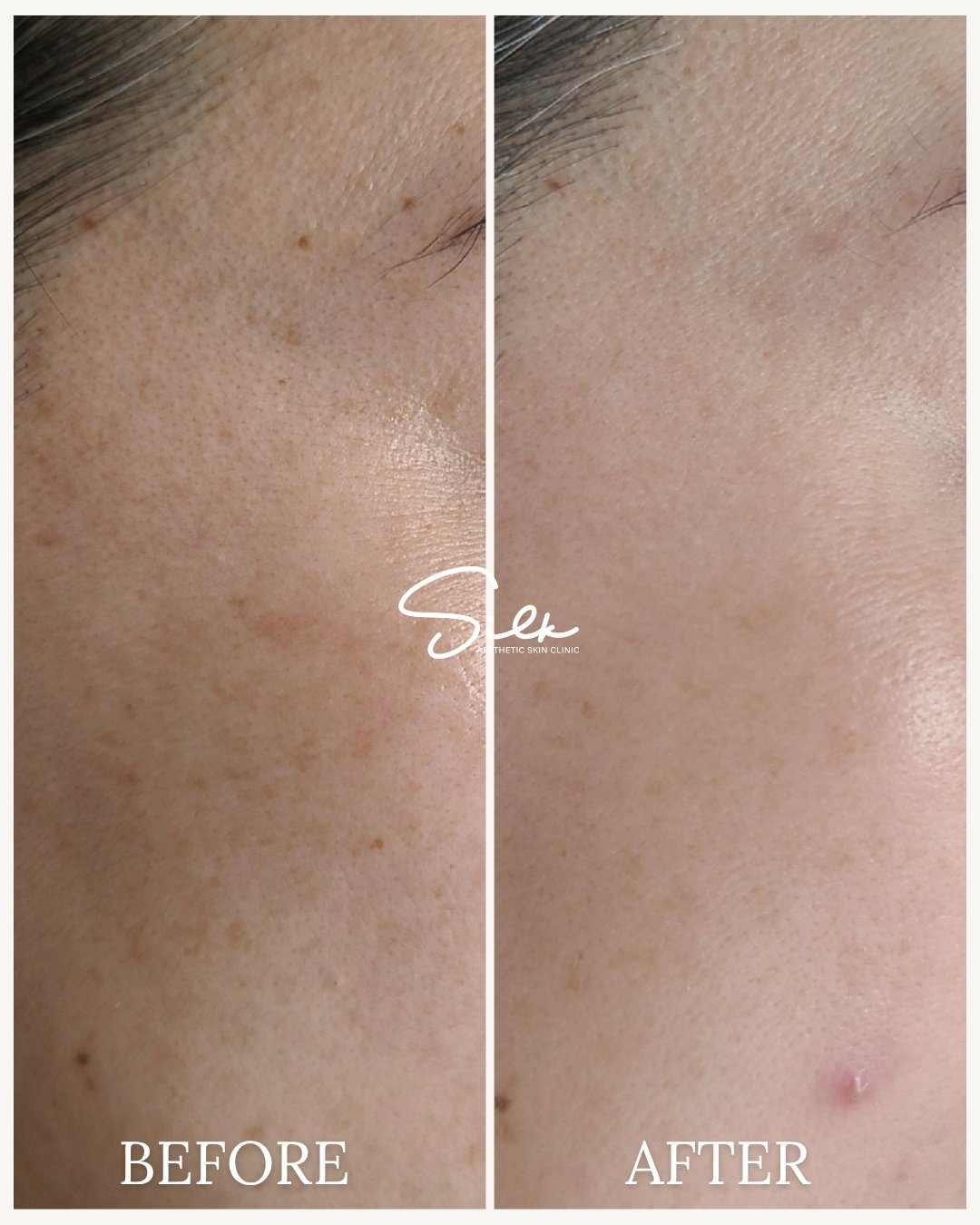 Melasma isn&rsquo;t just &ldquo;dark spots&rdquo;&hellip; and it&rsquo;s definitely not fixed overnight.

What you&rsquo;re seeing here is the result of targeted treatments, proper skincare, and consistency working together.
 Not guessing. Not overlo
