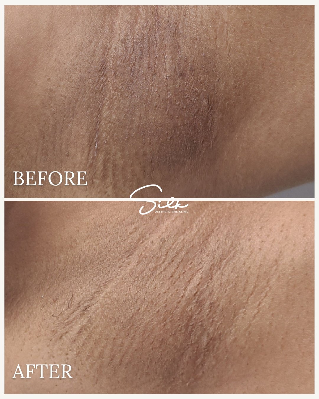 You don&rsquo;t have to settle for underarms you feel the need to hide.

Darkness in this area is common, but that doesn&rsquo;t mean it can&rsquo;t be improved.
 With the right treatments and consistency, you can gradually restore a brighter, smooth