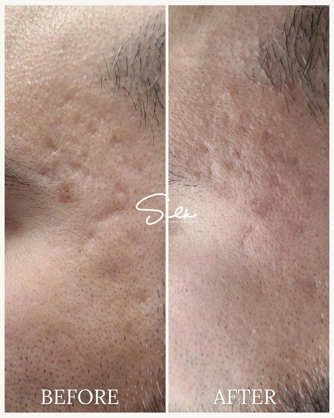 Still dealing with breakouts and uneven texture no matter what you use?

This is what happens when you stop guessing and start treating your skin the right way.

Acne isn&rsquo;t just about what you see on the surface.
 It&rsquo;s inflammation, conge