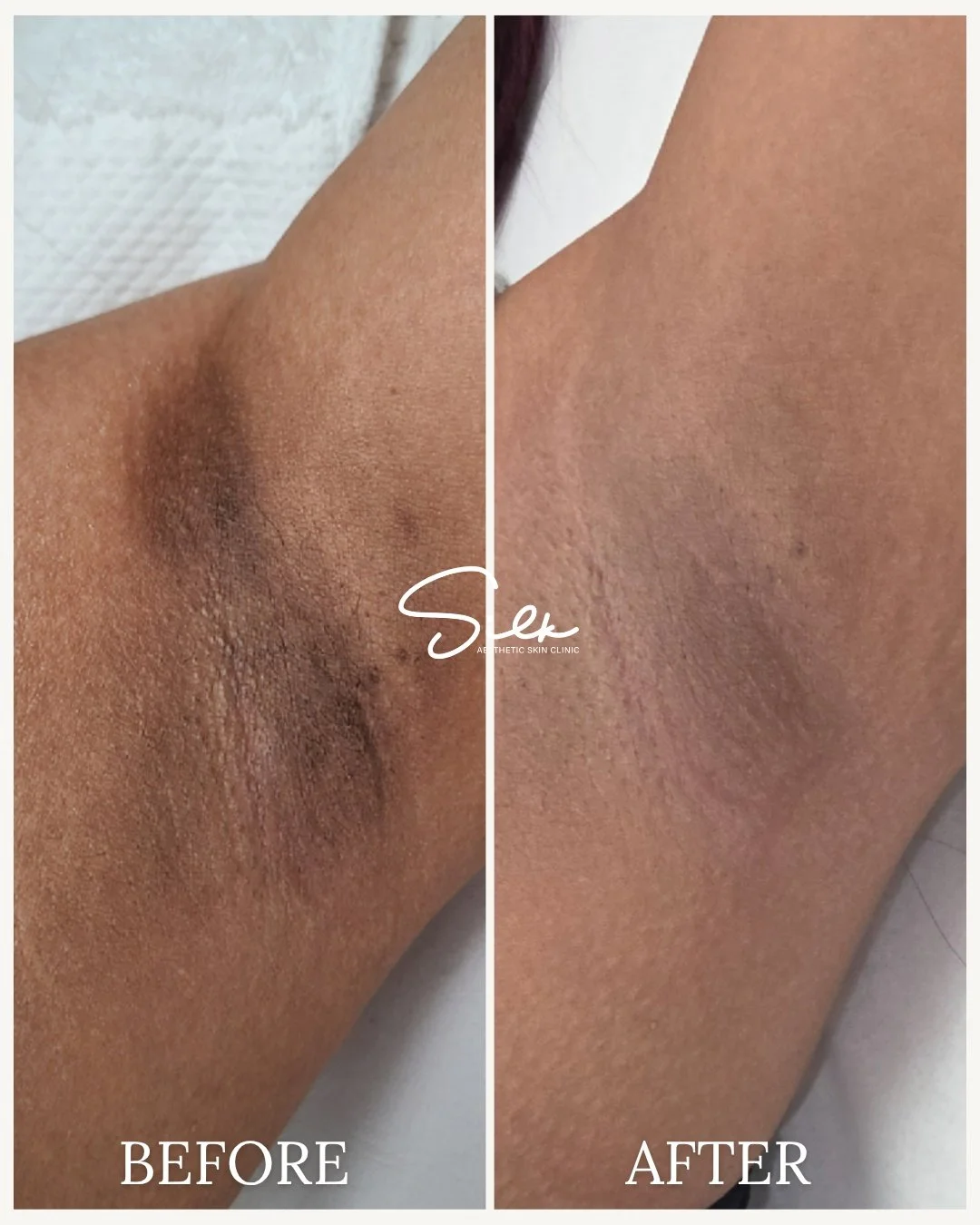 If you&rsquo;ve been hiding your underarms&hellip; this is your sign to stop.

Dark underarms don&rsquo;t just fade with time or products.

 They&rsquo;re often caused by years of friction, shaving, and buildup that need the right treatment to improv