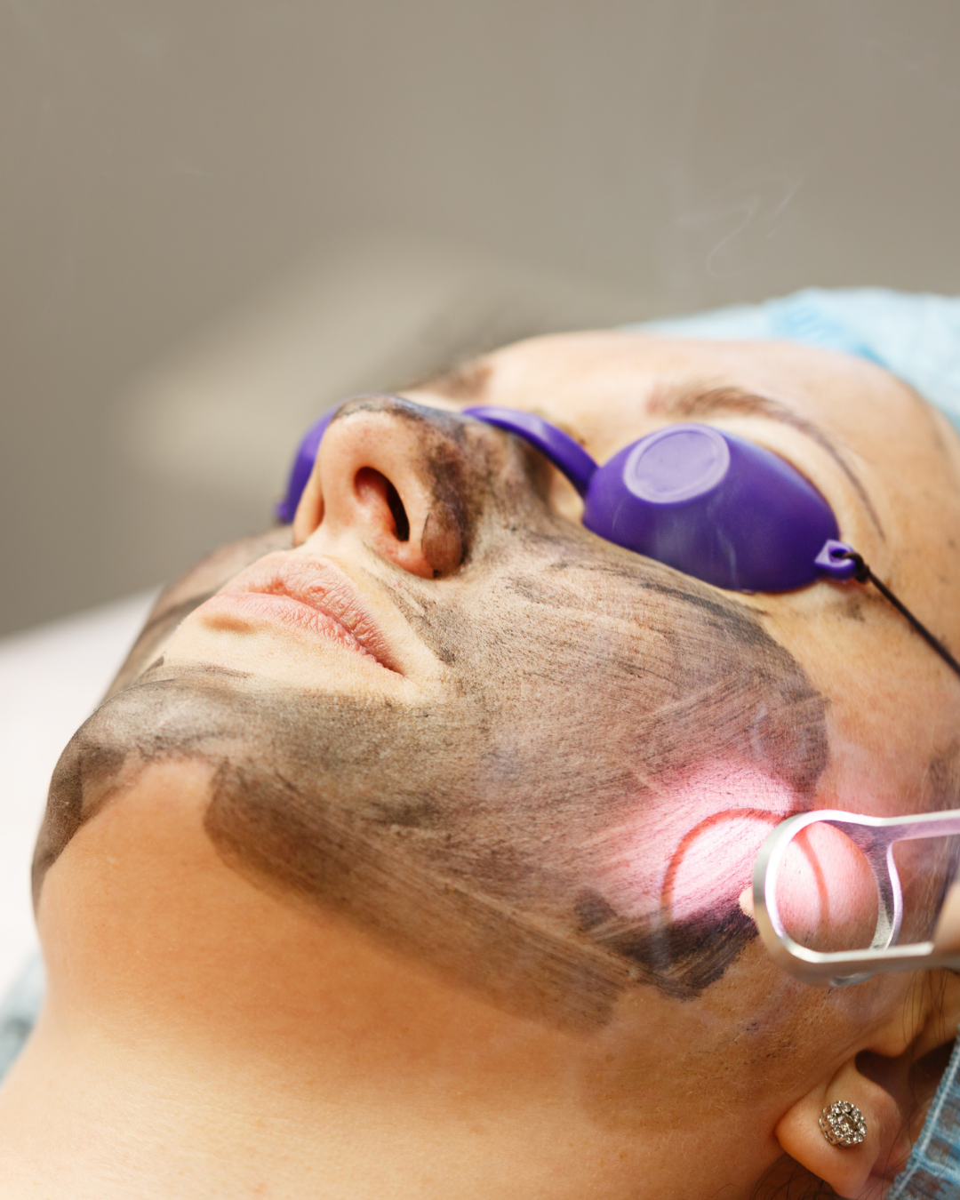 Why Spring Is the Best Time to Start Laser Treatments