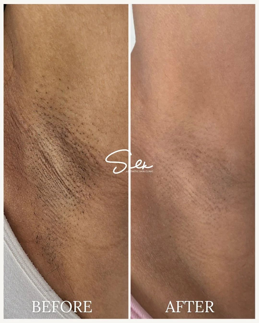 Still shaving every few days and dealing with shadow, bumps, and irritation?

This is what happens when you switch to Laser Hair Removal.

Instead of cutting hair at the surface, this treatment targets the root
 Helping reduce growth over time while 