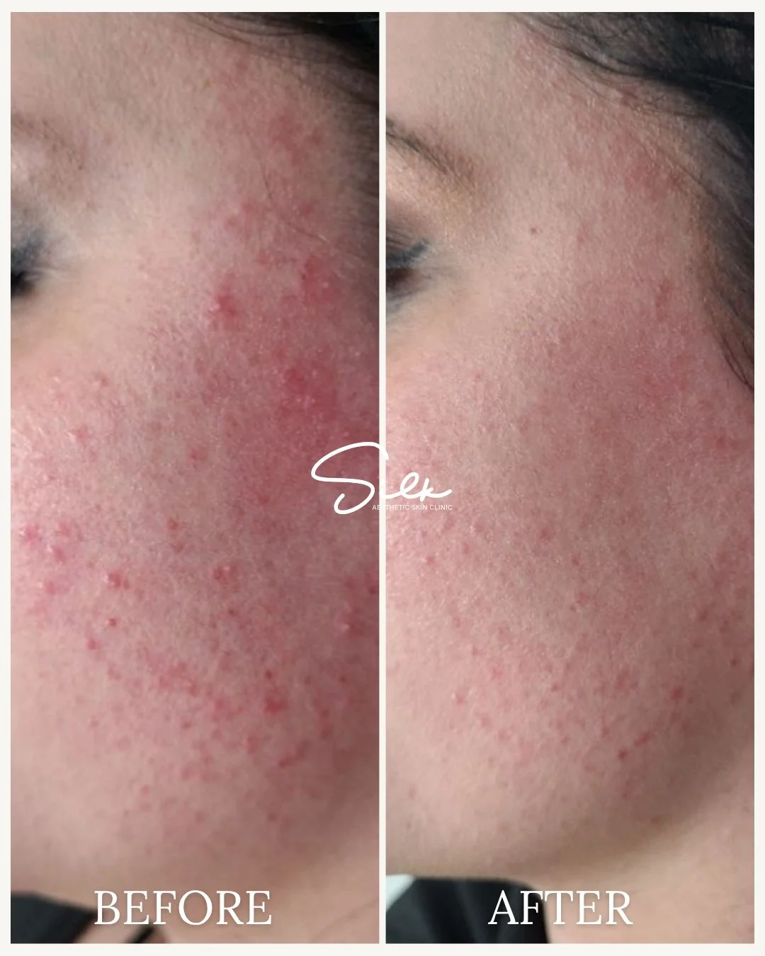Still breaking out even when you&rsquo;re doing everything right?

This transformation was achieved with Acne Laser Treatment designed to calm inflammation and support your skin&rsquo;s healing process from within.

✔ Helps reduce redness and active 