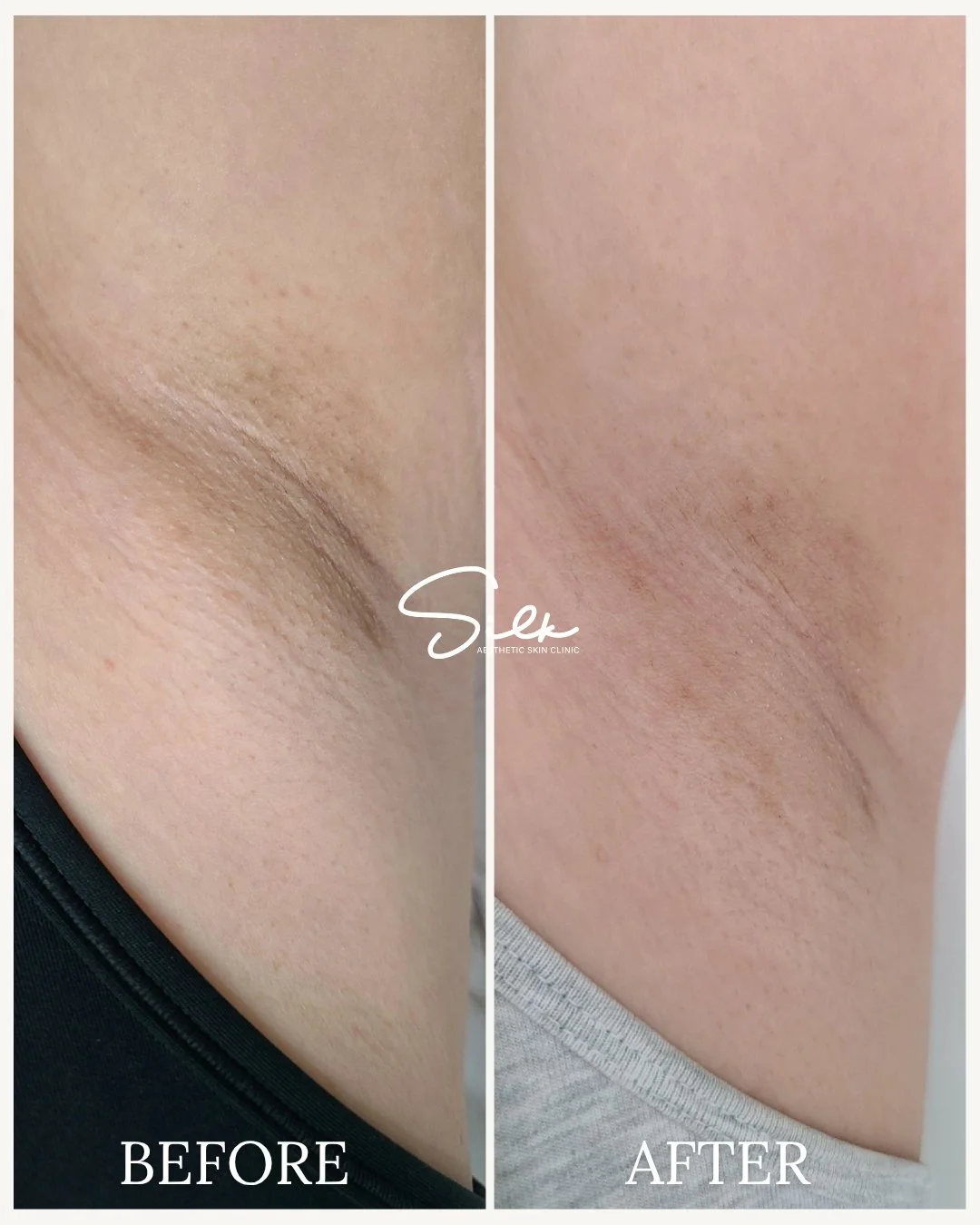 Say goodbye to dark spots and hello to smooth, even-toned underarms!

Unwanted pigmentation can make you self-conscious, but with our Underarm Skin Lightening Treatment, you can reveal fresh, brighter skin in just a few sessions!

This treatment targ