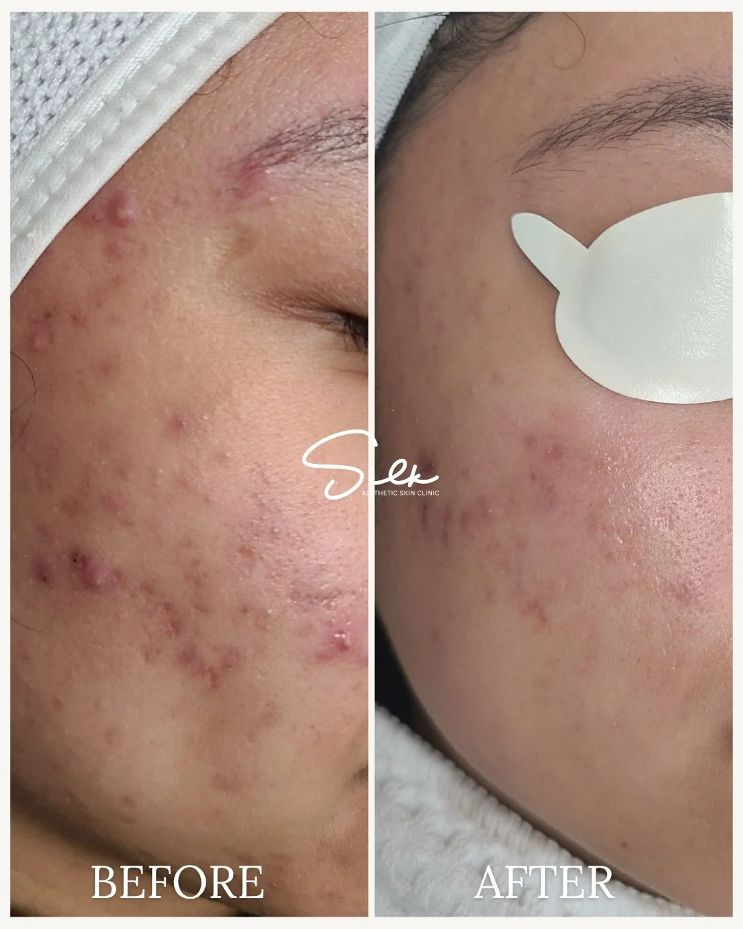 Struggling with breakouts? We&rsquo;ve got you covered!

Check out the results of our acne treatment, smoother, clearer skin in no time! If acne is holding you back, it&rsquo;s time to take control and treat it the right way.

Book your appointment t