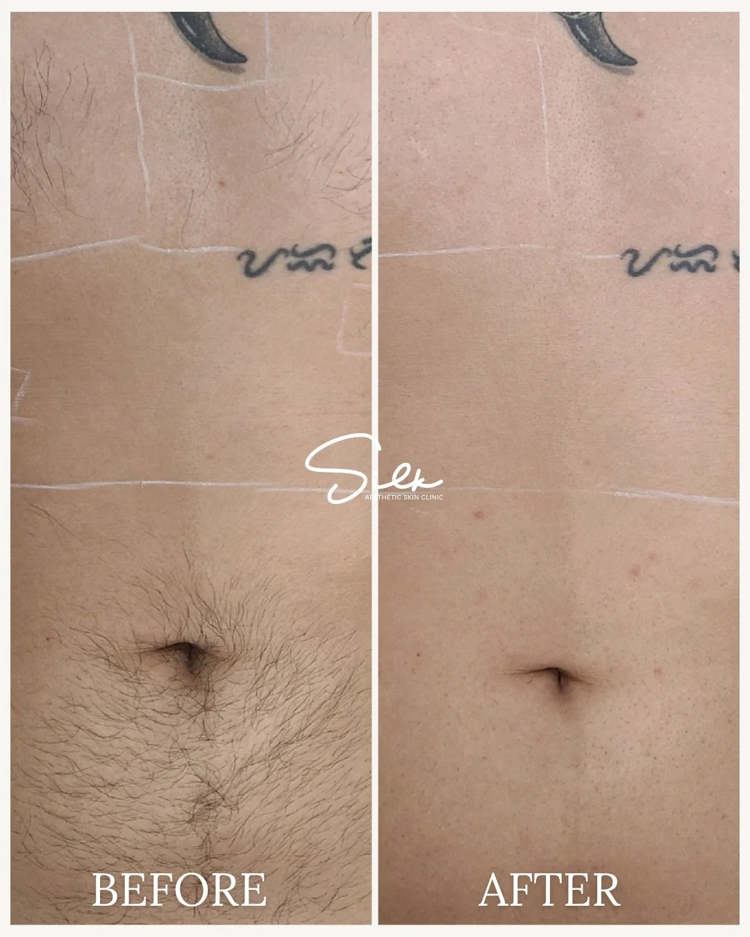 Say goodbye to shaving and hello to smooth skin!

Check out the incredible results of our laser hair removal treatment. No more razor bumps, ingrown hairs, or shaving frustrations, just smooth, hair-free skin that lasts.

Ready to make the switch? Bo