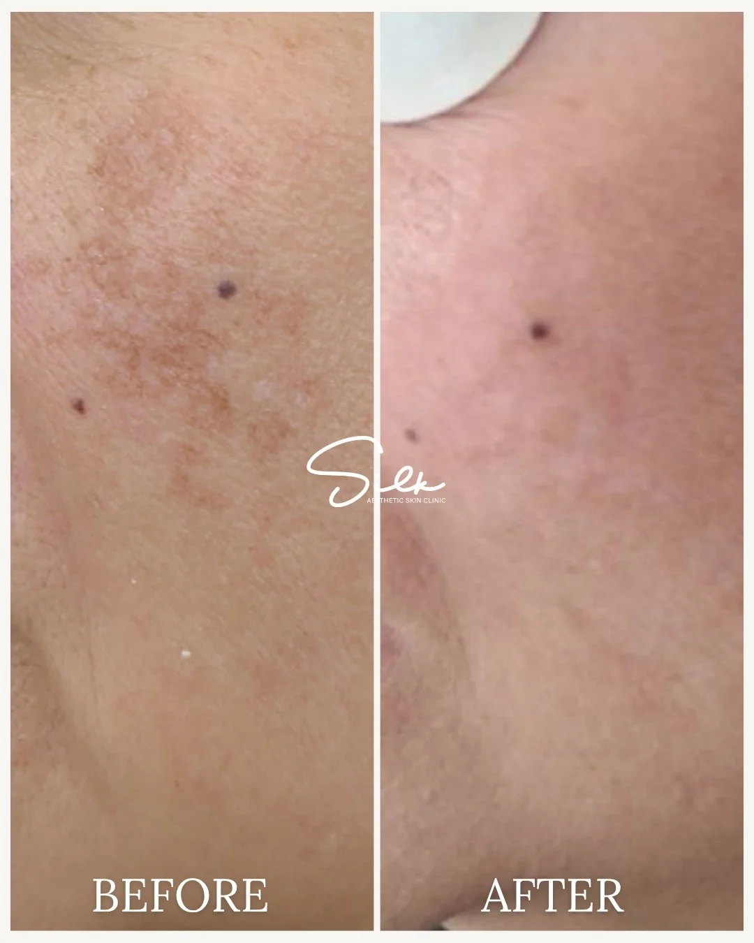 Say goodbye to stubborn melasma and hello to clear, even skin!

If you're tired of dealing with those dark spots that never seem to go away, it&rsquo;s time to experience the power of our Melasma Treatment. Watch as those spots fade away, revealing s