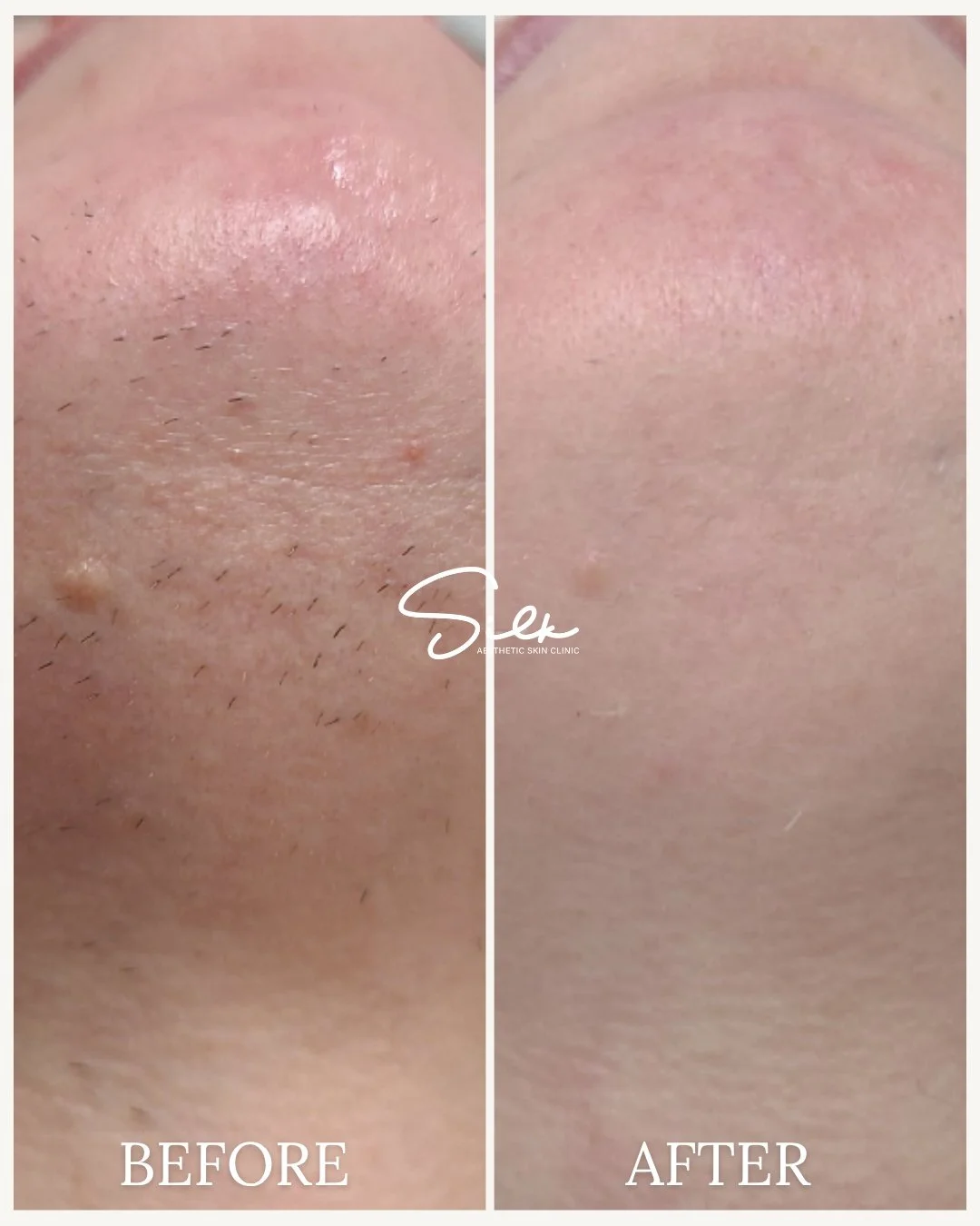 Smooth, flawless skin is just a session away!

If you're tired of shaving and waxing, why not skip the hassle and go for Laser Hair Removal? Check out this before and after, where stubborn hair is a thing of the past, leaving you with soft, hair-free