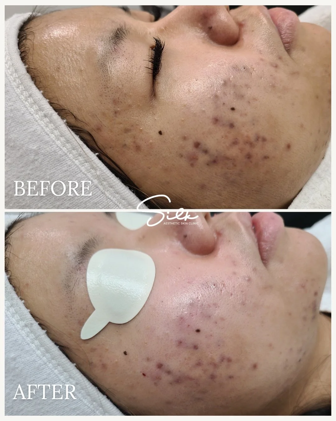 Clearer, smoother skin is just a treatment away!

Check out this amazing transformation from our Acne treatment at Silk Aesthetic Skin Clinic. The difference is clear; acne marks and uneven texture have significantly improved, giving our client a fre