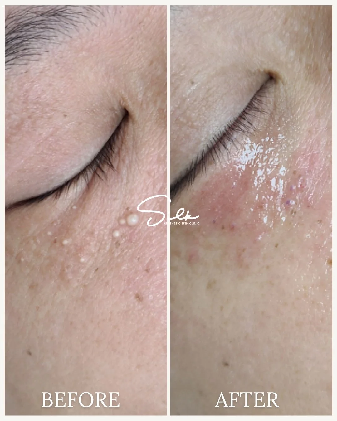 Say goodbye to pesky milia and hello to smoother skin!

This incredible transformation showcases the power of our [treatment name], effectively clearing up those stubborn white bumps and revealing fresh, rejuvenated skin! 🌟

Don&rsquo;t let milia ho