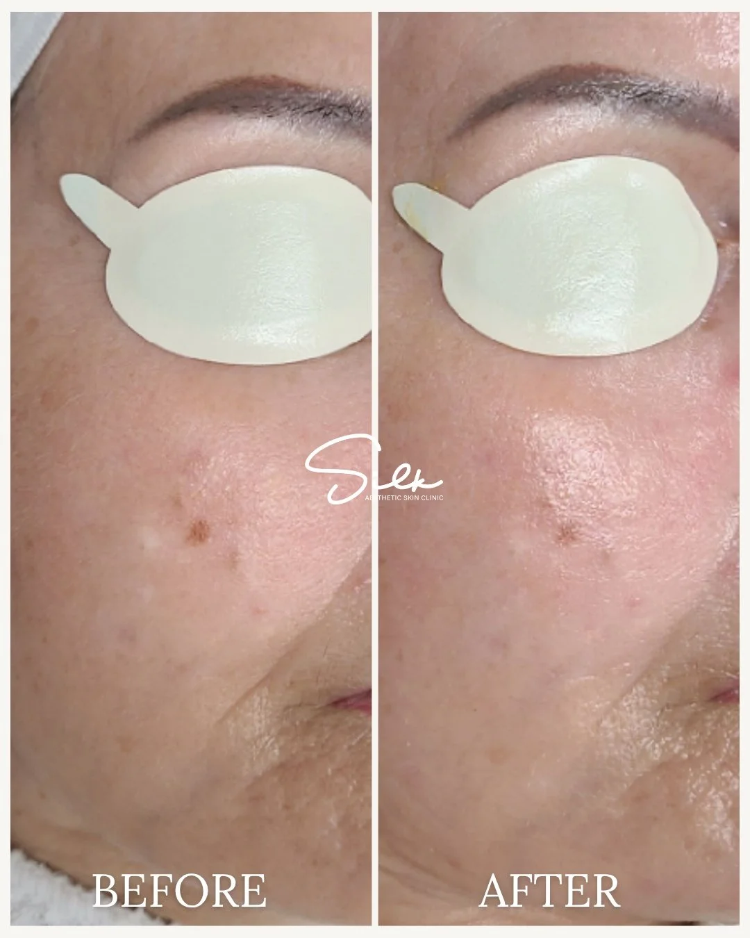 Visible improvements, just after one treatment!

This before-and-after showcases how our [treatment name] effectively targets and smooths the skin, leaving behind a refreshed and radiant look. 🌟 Say goodbye to stubborn spots and uneven texture!

Rea