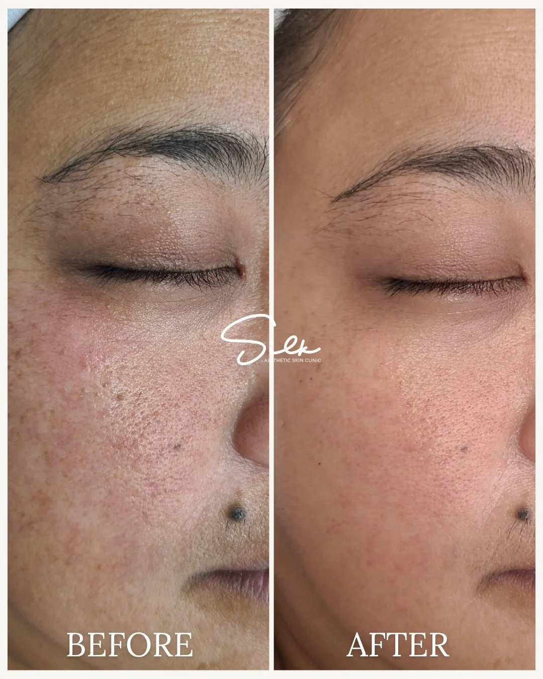 Some skin changes are subtle&hellip; until you put the before and after side by side. ✨

Smoother texture, softer pores, brighter skin, and that healthy glow starting to come through 🤍

Treatments like this are not about changing your skin overnight