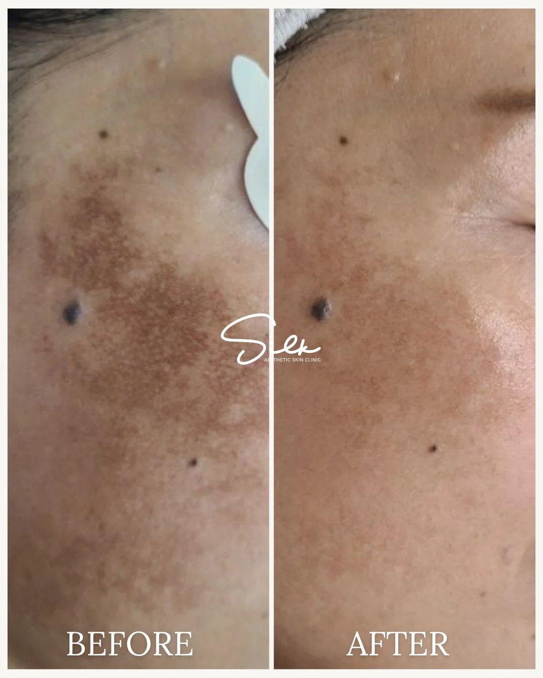 Melasma can be frustrating, stubborn, and hard to cover&hellip; but with the right treatment plan, progress is possible. ✨

This before and after shows visible improvement in uneven pigmentation and overall skin tone, leaving the skin looking brighte