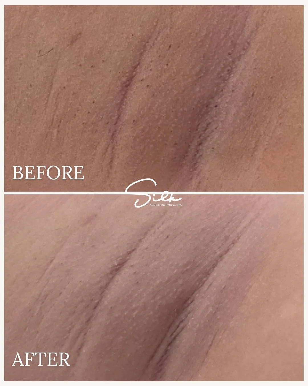 If you&rsquo;ve ever avoided sleeveless tops because of underarm darkness, you&rsquo;re not alone. 🤍

This before and after shows visible improvement in uneven tone and texture through our underarm skin lightening treatment. ✨

Smoother-looking, bri