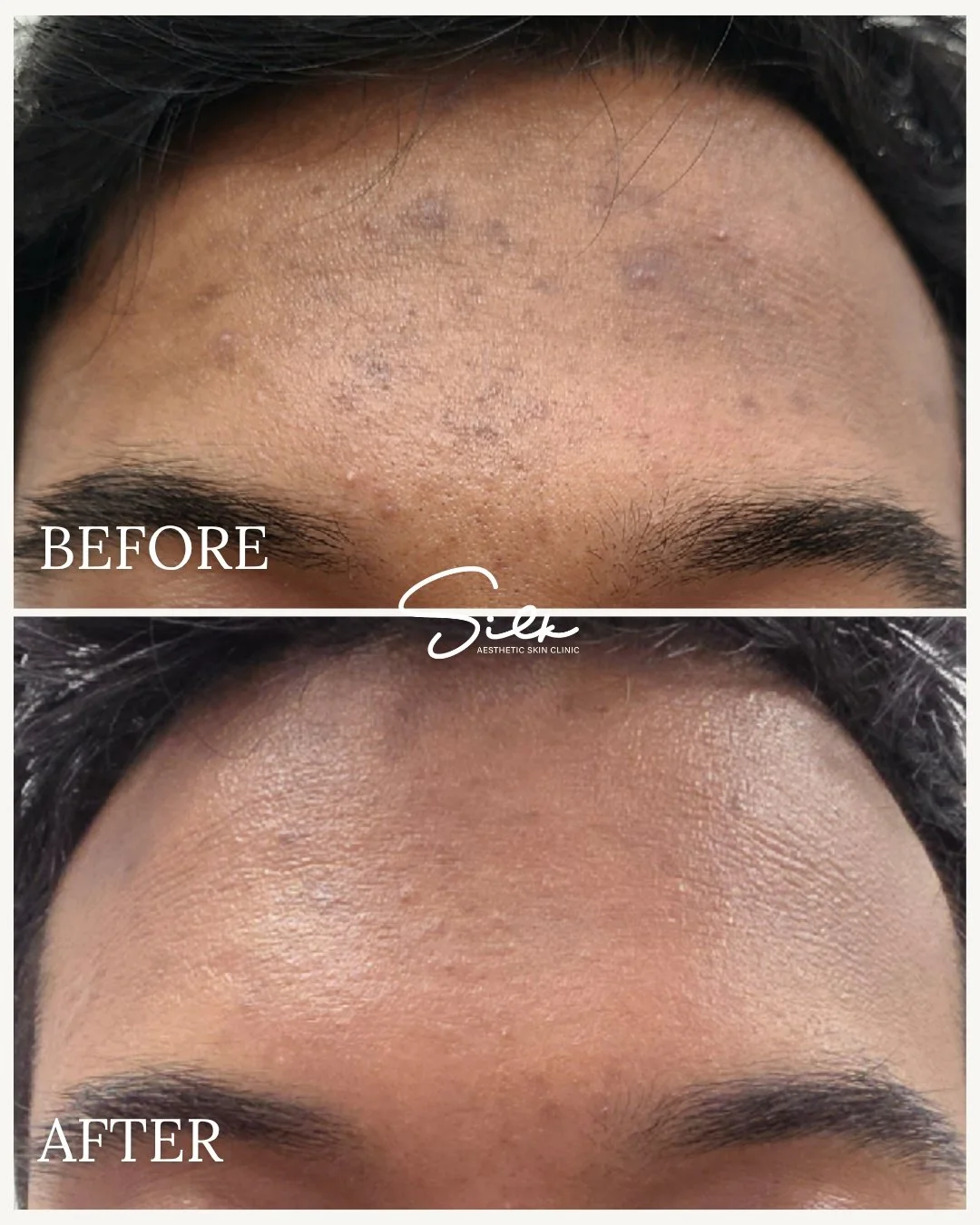 Clearer skin starts here! ✨

Check out this amazing transformation from acne-prone to smooth, radiant skin. With our expert acne treatments, we target breakouts, reduce inflammation, and improve overall skin texture for long-lasting results.

Your gl