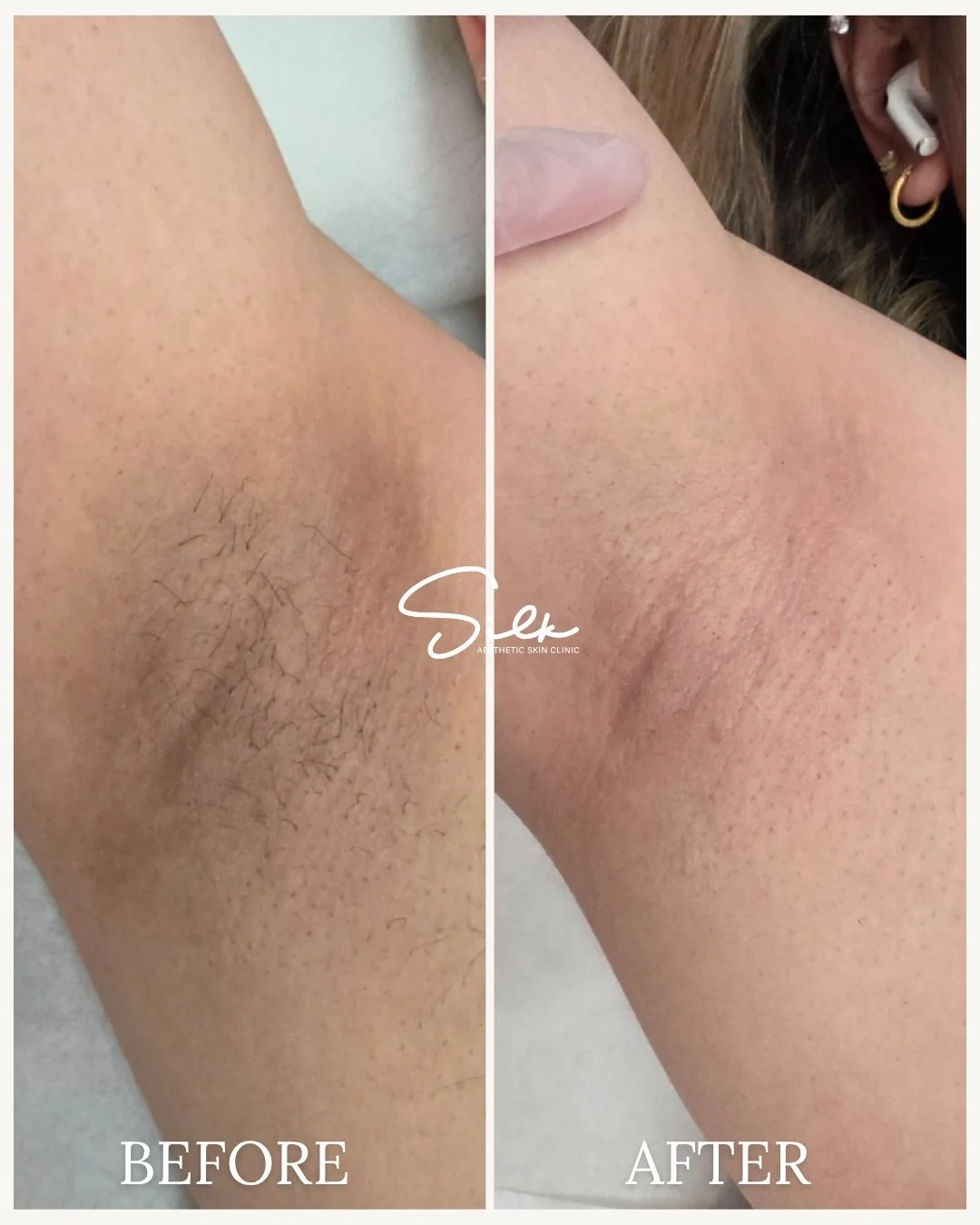 Say goodbye to shaving and hello to smooth, hair-free underarms! ✨

Check out this amazing transformation, laser hair removal at Silk Aesthetic leaves your skin smooth, even, and carefree. Perfect for summer confidence and effortless mornings.

Ready