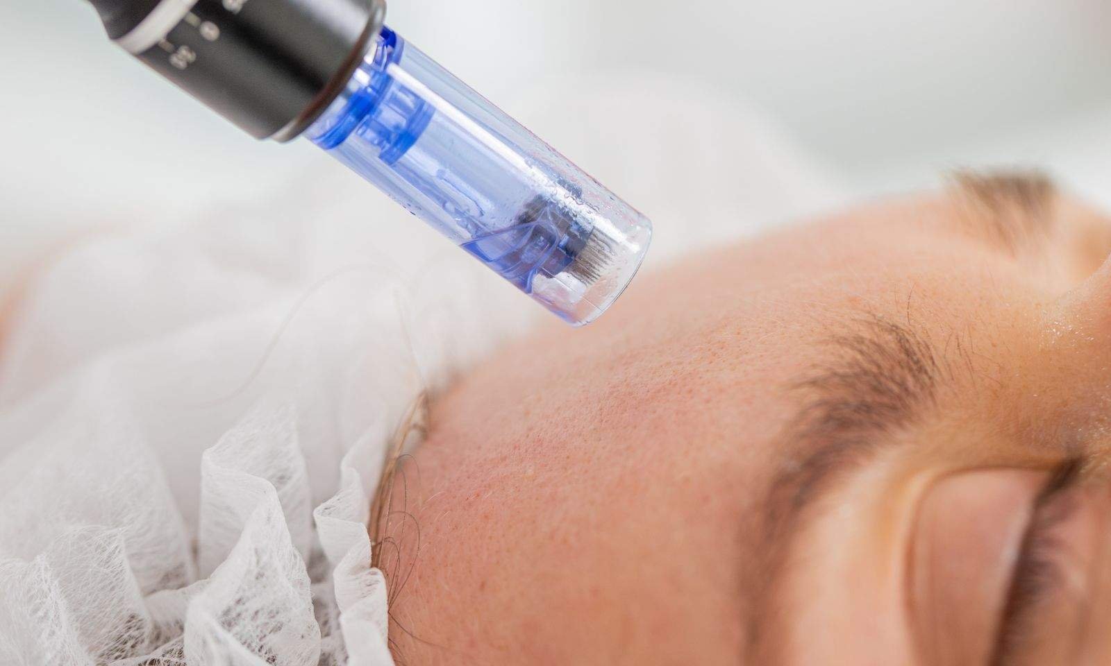 The Ultimate Skin Prep: Why Microneedling Is Perfect Before Summer Starts