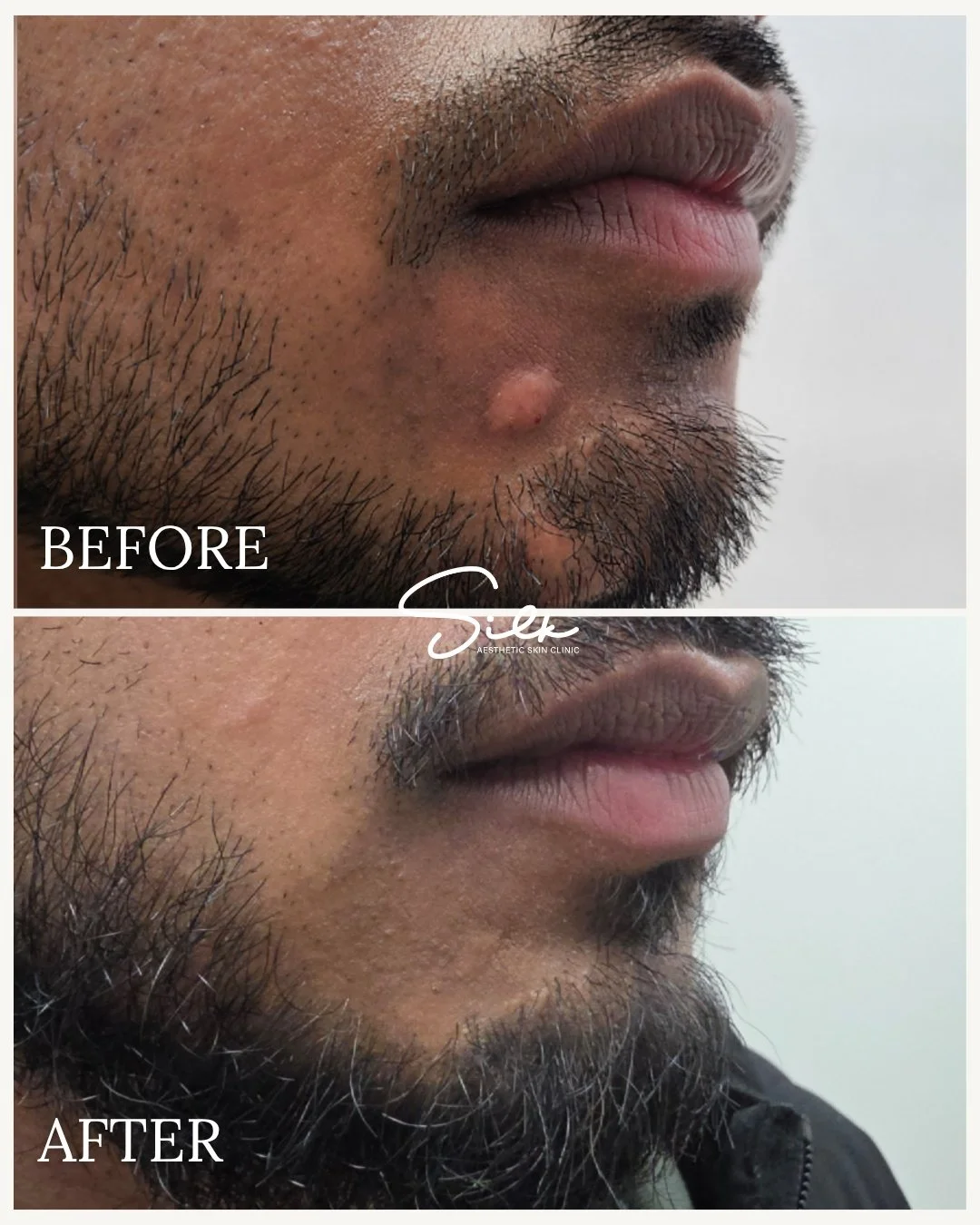 Say goodbye to stubborn bumps! ✨

Check out these amazing results, smooth, clearer skin after a single treatment! Treatments like this help reduce bumps, promote healing, and improve overall skin texture.

Ready to refresh your skin? Book your consul