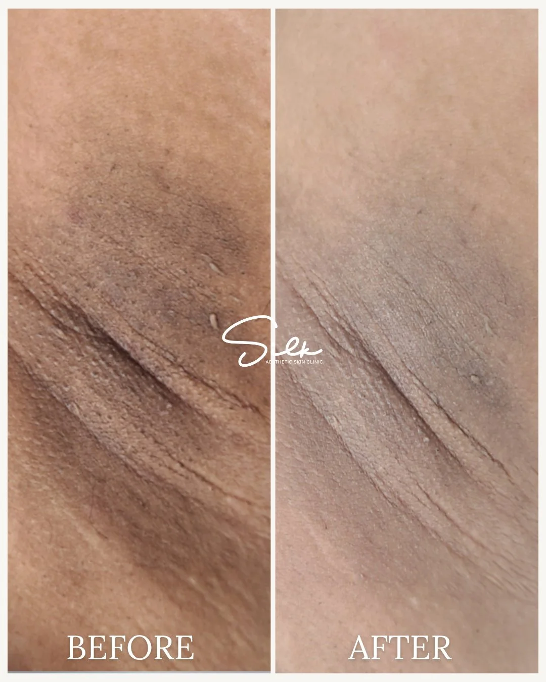 Reveal Brighter, Smoother Underarms! ✨

Say goodbye to dark, uneven underarms and hello to confidence! Our targeted underarm skin lightening treatment helps:

 ✔ Even skin tone
 ✔ Hydrate &amp; soften
 ✔ Reduce discoloration
 ✔ Boost confidence in sl