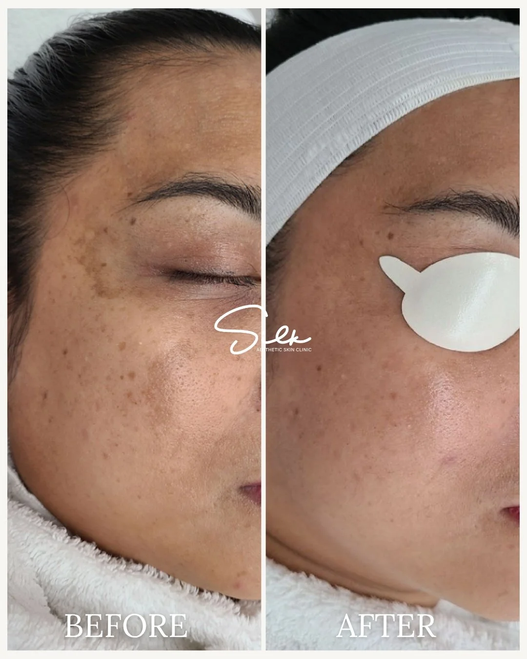 Say goodbye to stubborn dark spots! ✨

Our targeted melasma treatment helps lighten pigmentation, even skin tone, and restore your natural glow.

Benefits include:
 ✔ Reduced appearance of dark spots and hyperpigmentation
 ✔ Brighter, more radiant sk