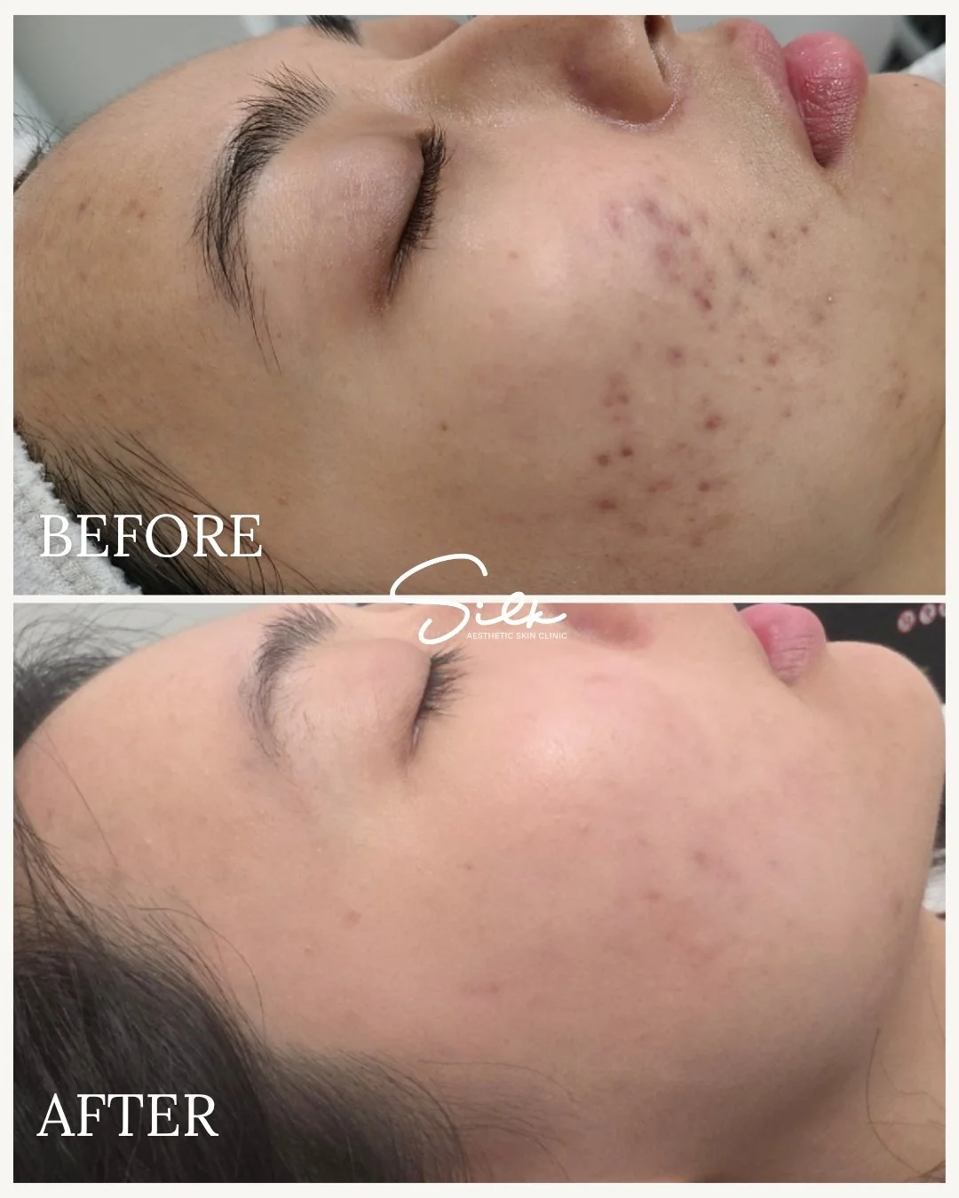 Say goodbye to stubborn breakouts and hello to smoother, clearer skin! ✨

Our targeted acne treatment helps:
 ✔ Reduce redness and inflammation
 ✔ Unclog pores and prevent future breakouts
 ✔ Promote healthy, balanced skin

The results speak for them