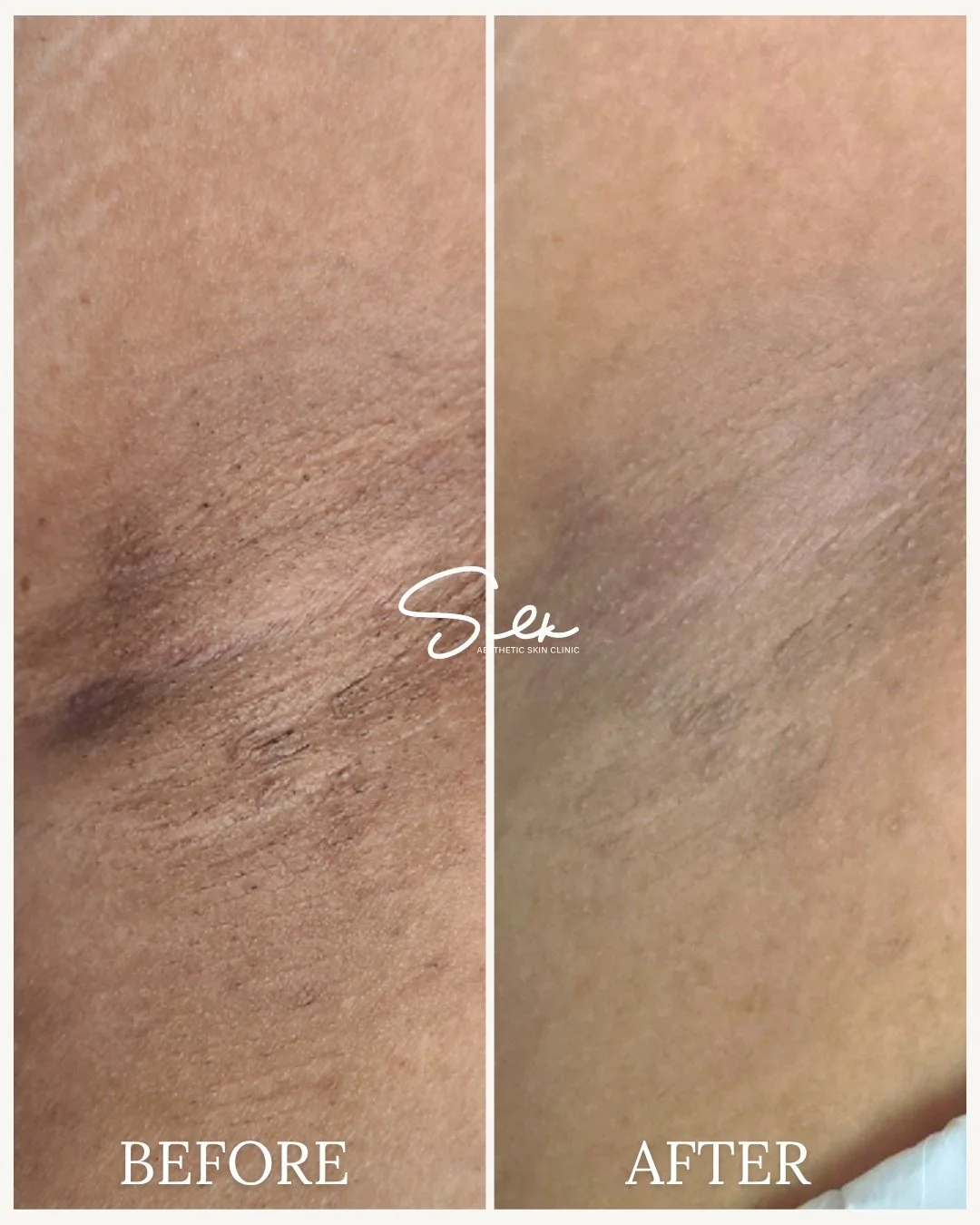Reveal Your Brightest Underarms Yet! 🌟

Our underarm skin lightening treatment helps even out tone, smooth texture, and boost confidence.

Benefits:
✔ Reduces dark spots and discoloration
✔ Smooths and softens skin
✔ Restores even tone
✔ Boosts conf