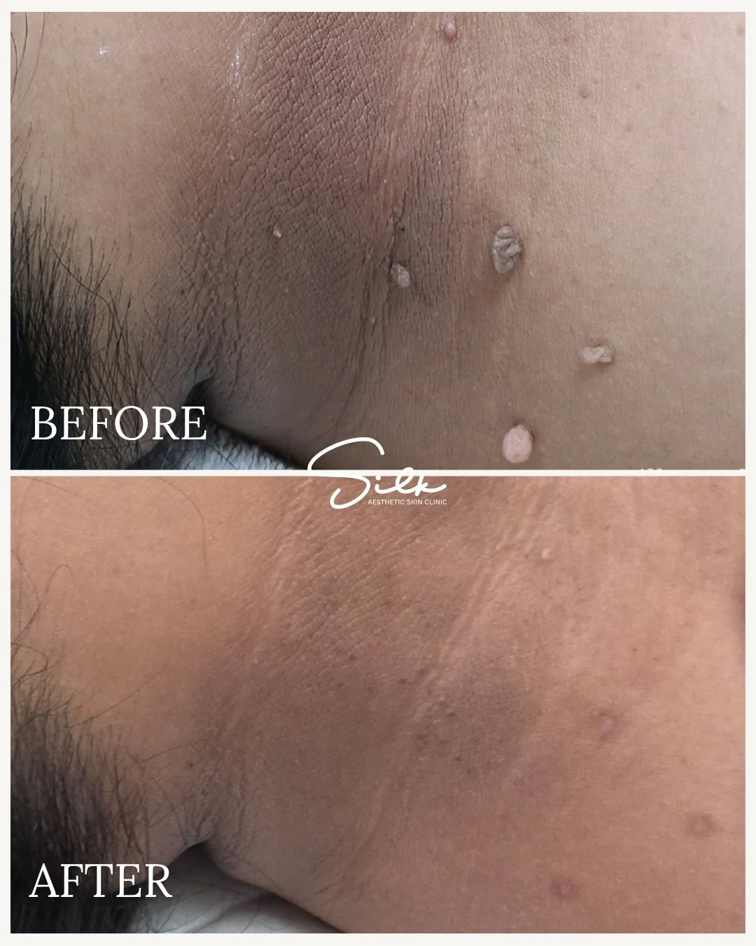 Say goodbye to unwanted skin tags! ✨

Check out this amazing transformation, smooth, clean, and refreshed underarm skin after our precise skin tag removal treatment. Safe, effective, and gentle for all skin types!

Benefits:
✔ Removes skin tags quick