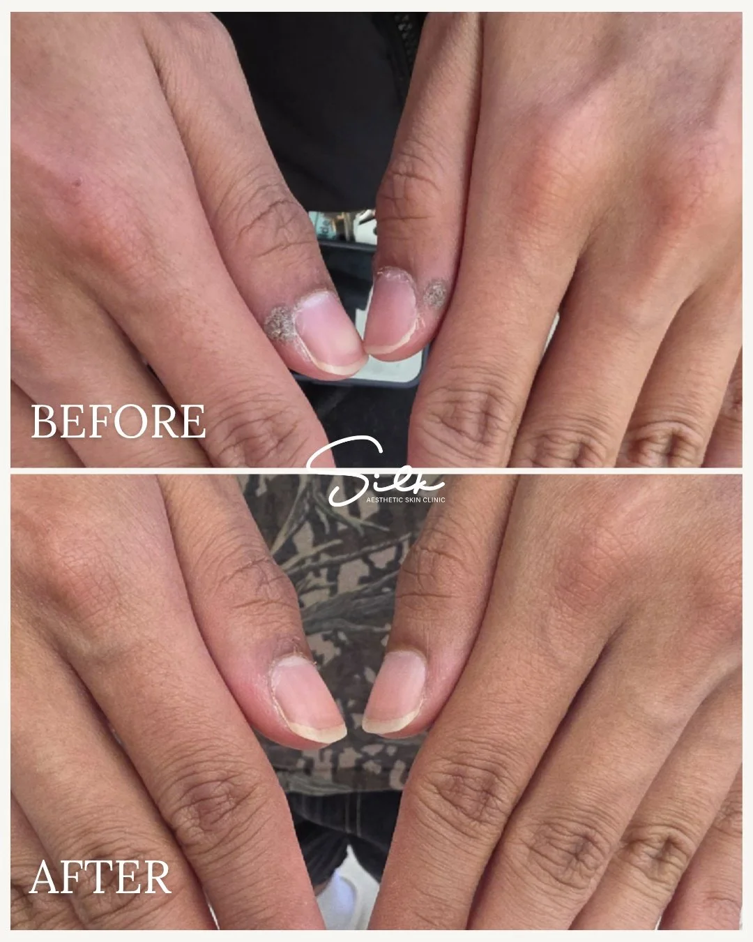 Nails looking off lately? Let&rsquo;s fix that! ✨

Our Nail Wart Treatment safely targets stubborn warts, restores healthy nail growth, and leaves your nails smooth and clean. Check out these results, real nails, real transformation.

Benefits:
✔ Rem