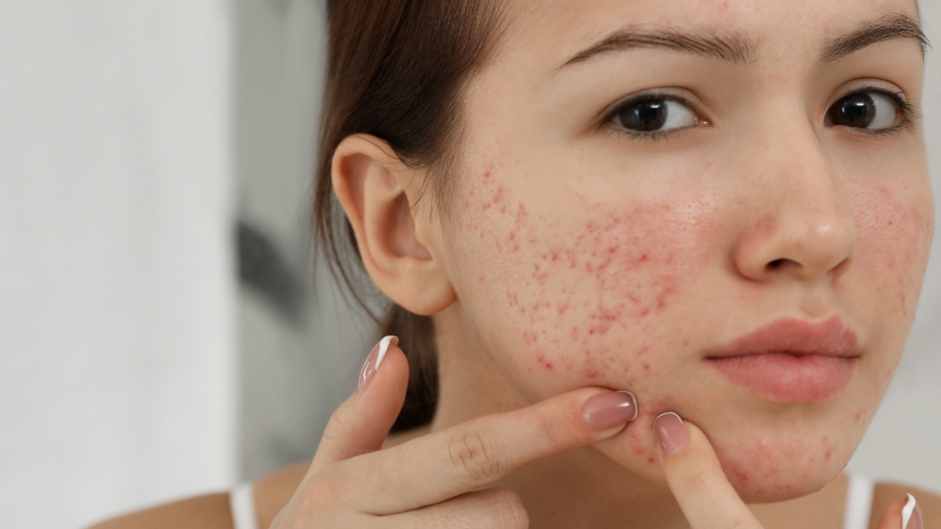 5 Common Acne Mistakes That Could Be Making Your Skin Worse