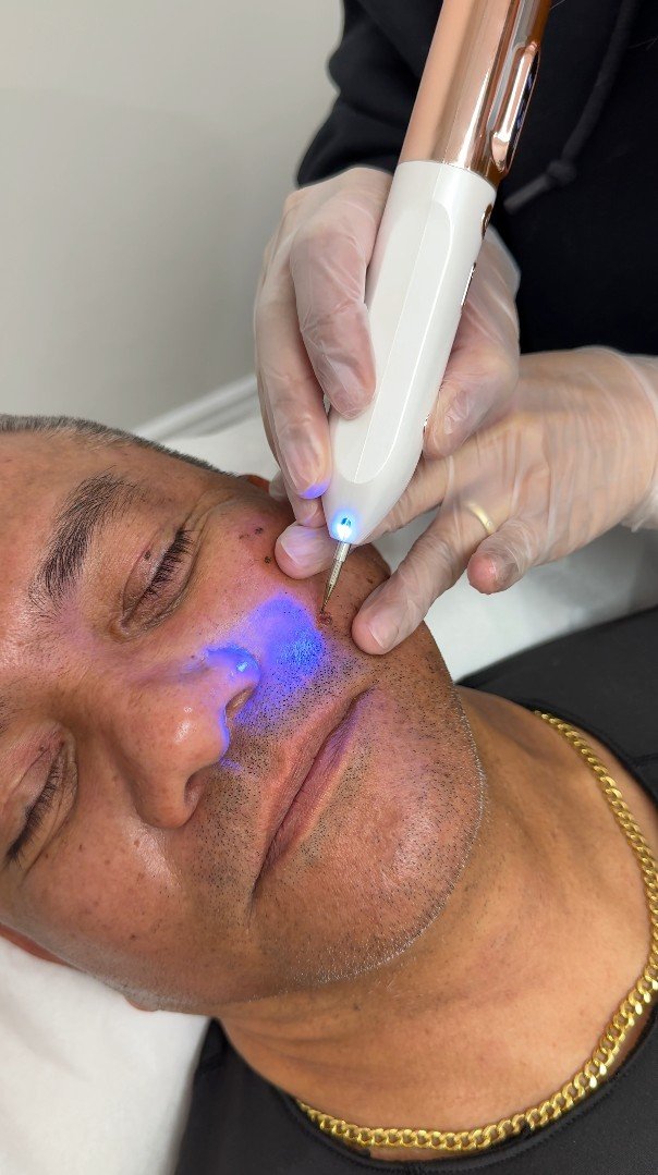 A man receiving a blue light treatment on his face with a handheld device from a gloved clinician.