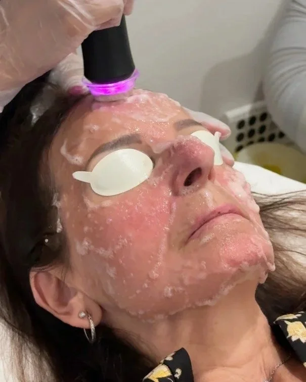 A woman receiving a facial treatment with a handheld device on her forehead, while her eyes are covered with protective eye pads.
