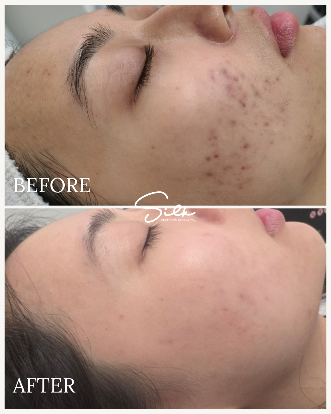 Side-by-side comparison of a woman's face before and after skincare treatment, showing significant reduction in acne and skin blemishes.