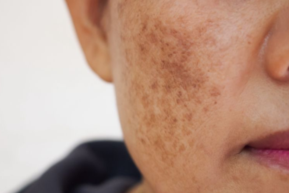 Melasma vs. Hyperpigmentation: What’s the Difference? — Silk Aesthetic ...