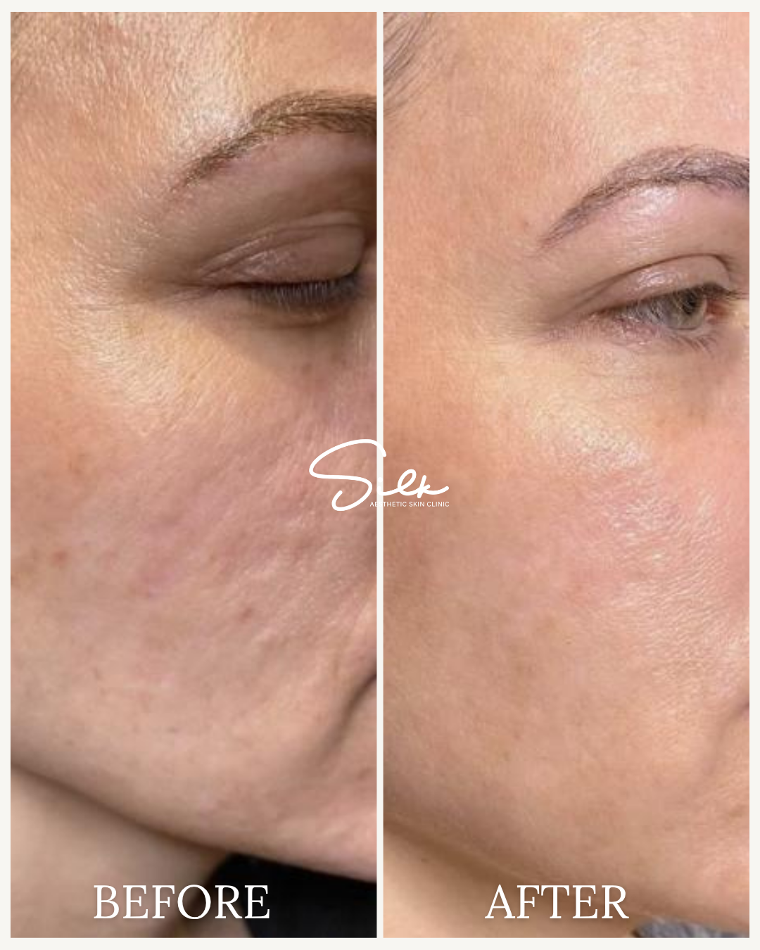 Close-up side-by-side comparison of a woman's face showing skin improvement. The left side labeled 'Before' displays acne scars, uneven skin texture, and pigmentation. The right side labeled 'After' shows smoother, clearer, and more even skin. The image includes the logo 'Sex Aesthetic Skin Clinic' in the center.