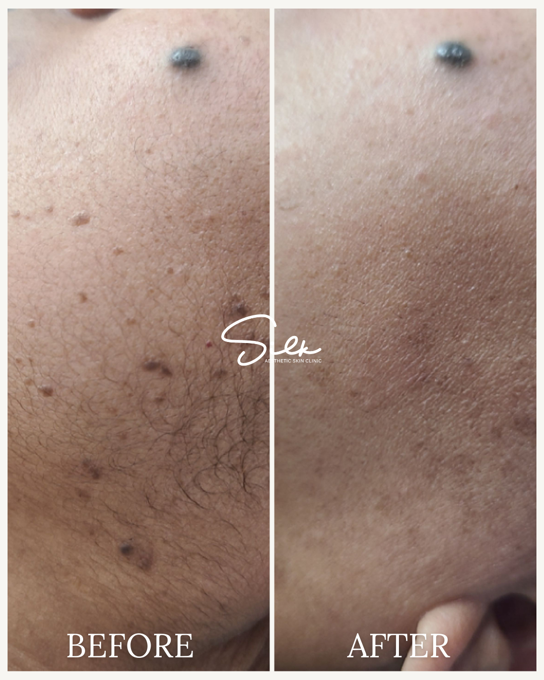Side-by-side comparison of a person's facial skin before and after skin treatment, showing reduced pores, acne scars, and smoother skin in the after image.