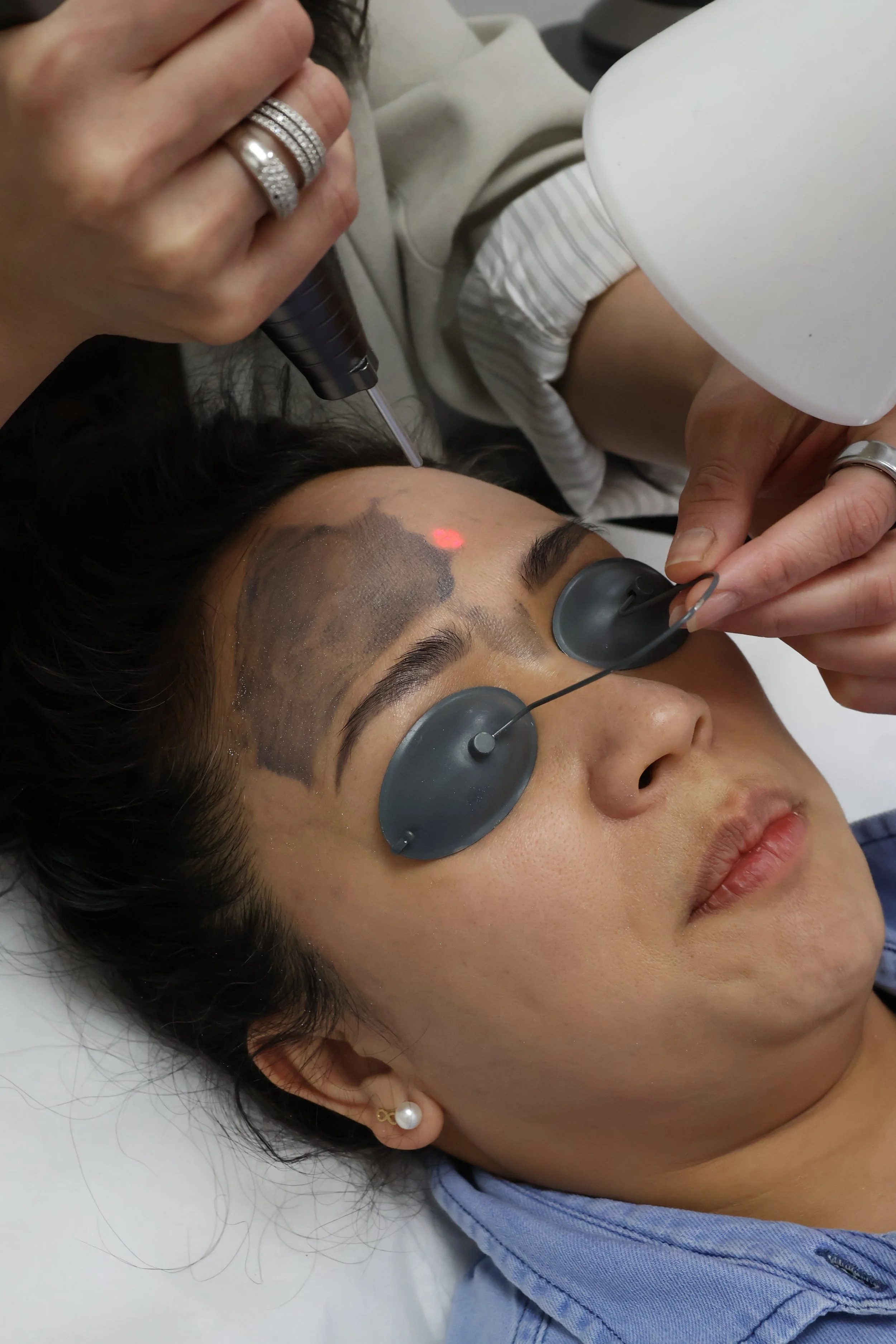 A woman lying down with medical eye equipment and a laser device near her forehead, receiving a procedure on her forehead and eyebrow area.