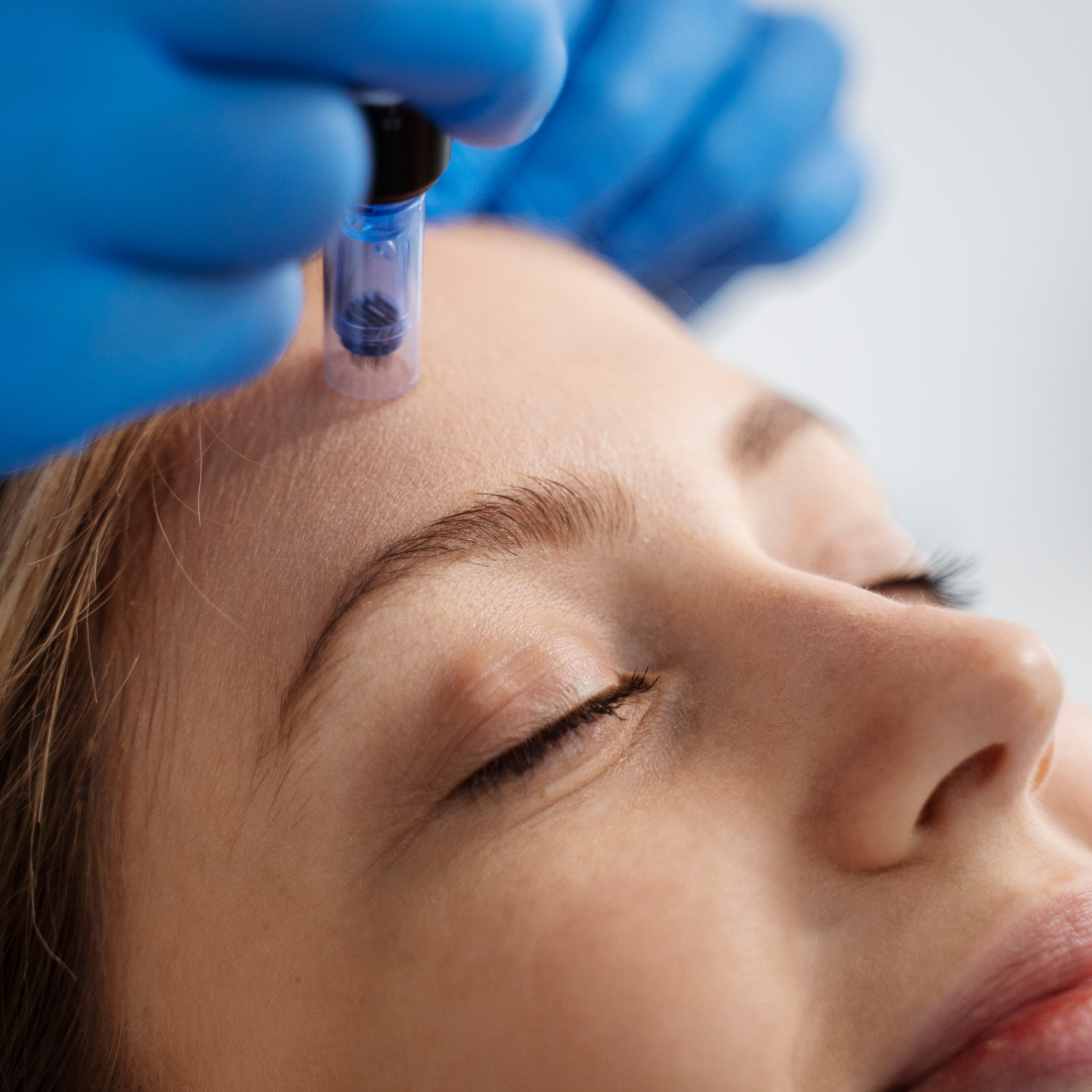 Microneedling Face