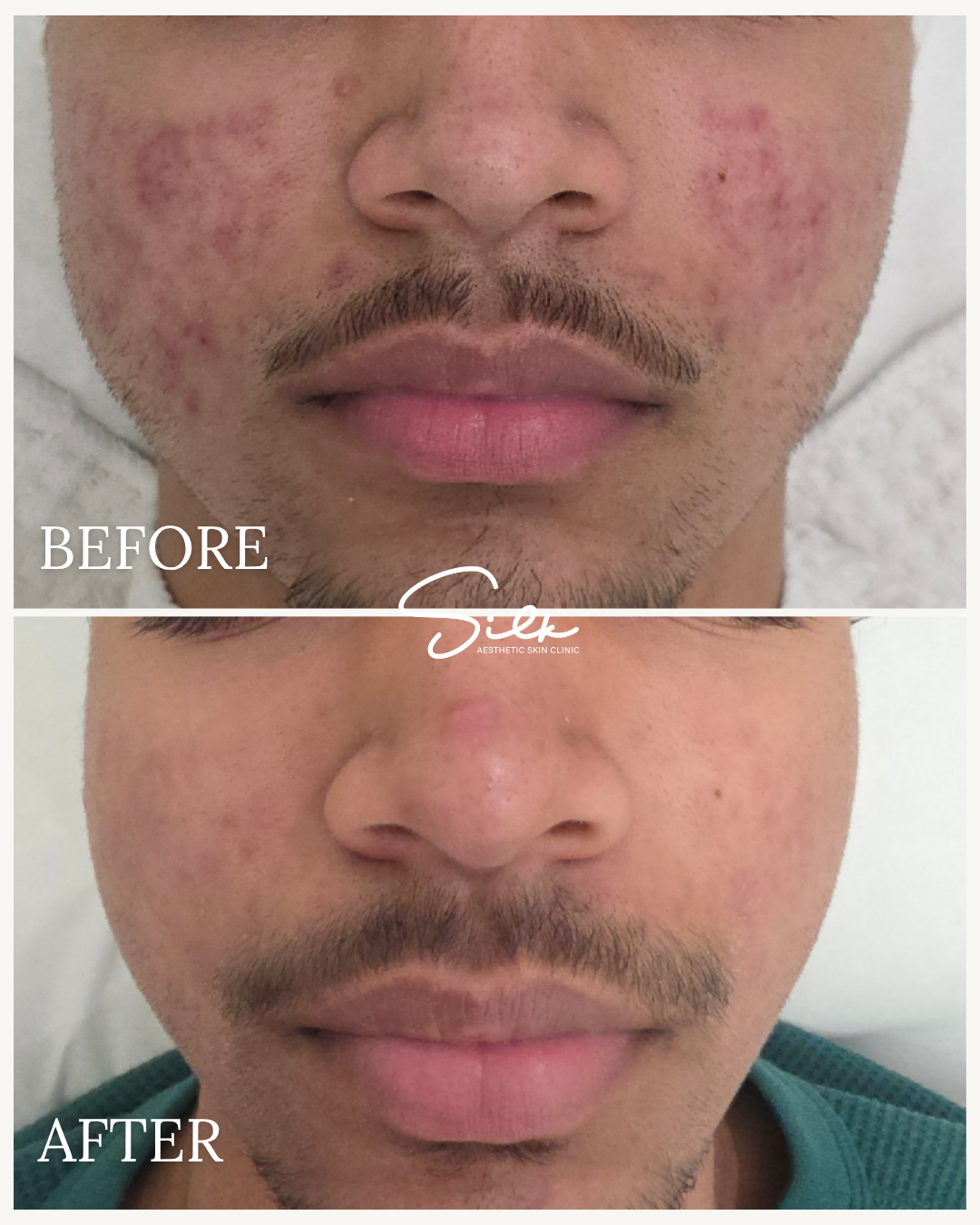 Close-up comparison of a man's face showing skin acne before and after treatment, with clear skin in the after photo.