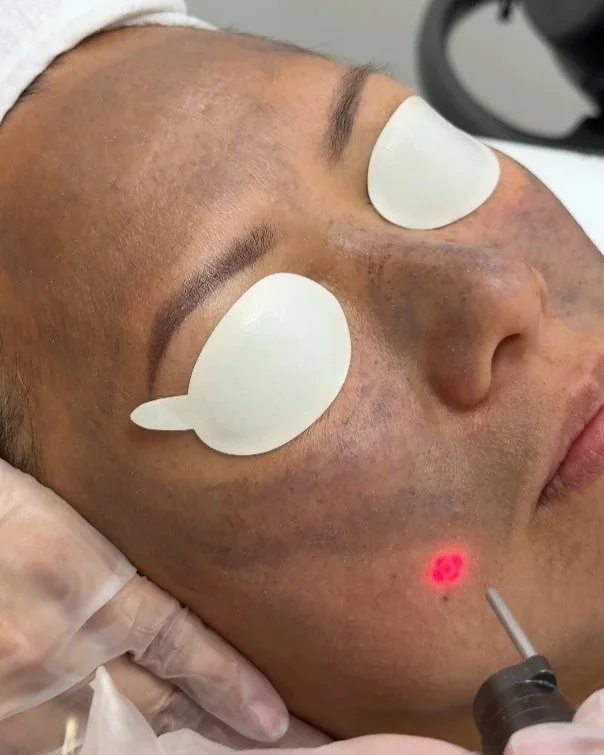A person lying down during a cosmetic procedure, with eye masks covering their eyes, receiving laser treatment on their cheek.