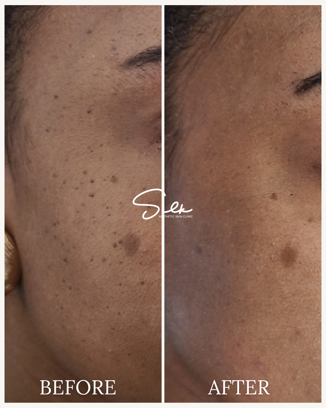 Close-up of a woman's cheek showing a before-and-after comparison of skin treatment. The left side shows acne scars and dark spots, while the right side shows clearer, smoother skin after treatment.