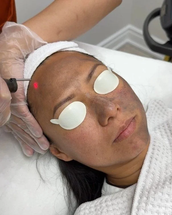 Close-up of woman receiving a laser skin treatment on her forehead, with protective eye patches and a medical professional wearing gloves.