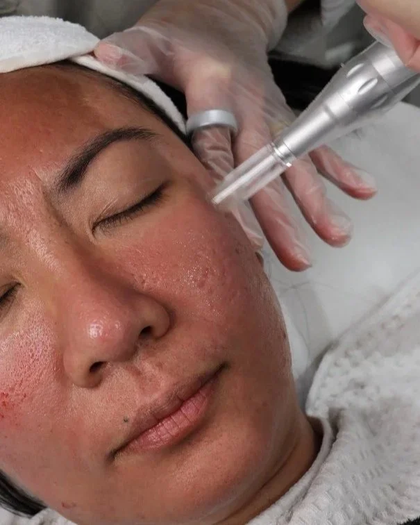 Close-up of a woman receiving a facial treatment with a professional using a skincare device on her face.