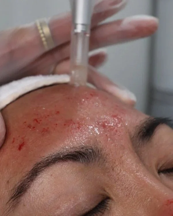 Close-up of a person receiving a facial treatment with a microdermabrasion device, showing redness and irritation on the forehead.
