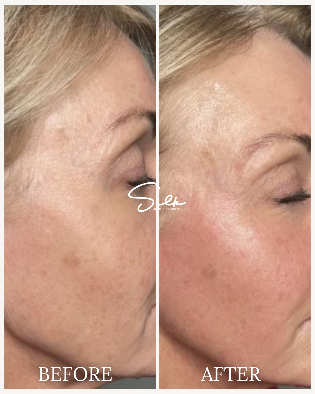 Side-by-side comparison of a woman's cheek before and after skin treatment, showing improved skin texture and reduced pigmentation in the after photo.